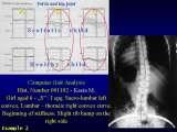 Two LECTURE on SCOLIOSIS in REGENSBURG / 10-14.05.2007