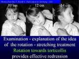 TORTICOLLIS/Wry Neck/Kr�cz szyi/LECTURE in Hungary
