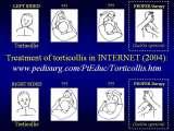 TORTICOLLIS/Wry Neck/Krcz szyi/LECTURE in Hungary