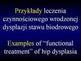 DDH/Cong.luxation of hip/LUBLIN method ot therapy/LECTURE