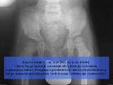 DDH/Cong.luxation of hip/LUBLIN method ot therapy/LECTURE