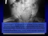 DDH/Cong.luxation of hip/LUBLIN method ot therapy/LECTURE