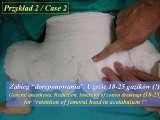 DDH/Cong.luxation of hip/LUBLIN method ot therapy/LECTURE