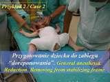 DDH/Cong.luxation of hip/LUBLIN method ot therapy/LECTURE