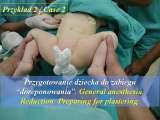 DDH/Cong.luxation of hip/LUBLIN method ot therapy/LECTURE