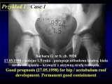 DDH/Cong.luxation of hip/LUBLIN method ot therapy/LECTURE