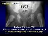 DDH/Cong.luxation of hip/LUBLIN method ot therapy/LECTURE