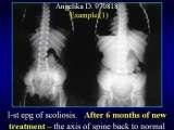 SYNDROME of CONTRACTURES-Hip Dysplasia / DDH / WryNeck/M.Blount/SCOL./LECTURES