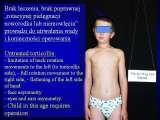 SYNDROME of CONTRACTURES-Hip Dysplasia / DDH / WryNeck/M.Blount/SCOL./LECTURES