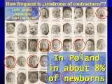 SYNDROME of CONTRACTURES-Hip Dysplasia / DDH / WryNeck/M.Blount/SCOL./LECTURES