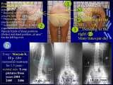 SICOT/2007/MAROCCO/Marrakech/SOSORT 2008/Athens/Recent LECTURE on scoliosis