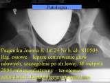 Biodra bolesne/Imperfect hips/Ureife Huften/LECTURE