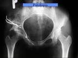 Biodra bolesne/Imperfect hips/Ureife Huften/LECTURE