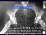 Biodra bolesne/Imperfect hips/Ureife Huften/LECTURE