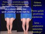 BLOUNT DISEASE/Golenie szpotawe/LECTURE/Knee Valgus Deformity/Prague/19.10.07
