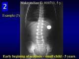 RECENT fundamental KNOWLEDGE on SCOLIOSIS/Orthop.Congress/Cairo/Egypt/LECTURE