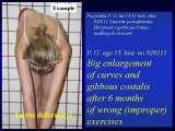 New Fundamental Knowledge on Scoliosis. SCIENCE versus OPINION / LECTURE