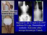 SICOT/LECTURE/SCOLIOSIS / 8th May 2009 / Kolobrzeg / Poland