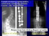 SICOT/LECTURE/SCOLIOSIS / 8th May 2009 / Kolobrzeg / Poland