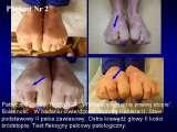 Test fleksyjny palc�w stopy / Flexions test of toes LECTURE