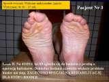 Test fleksyjny palc�w stopy / Flexions test of toes LECTURE