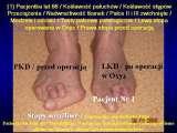 Test fleksyjny palc�w stopy / Flexions test of toes LECTURE