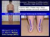 CEREBRAL PALSY, MPDZ / Mozgowe porazenie dziec. IZP. LECTURE