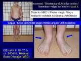 CEREBRAL PALSY, MPDZ / Mozgowe porazenie dziec. IZP. LECTURE