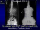 TWO LECTURES on scoliosis / Orthop.Congress in CAIRO-8.12.2006