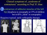 SYNDROME of CONTRACTURES-Hip Dysplasia / DDH / WryNeck/M.Blount/SCOL./LECTURES