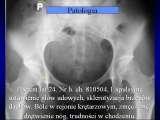 Biodra bolesne/Imperfect hips/Ureife Huften/LECTURE