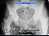 Biodra bolesne/Imperfect hips/Ureife Huften/LECTURE