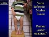 BLOUNT DISEASE/Golenie szpotawe/LECTURE/Knee Valgus Deformity/Prague/19.10.07