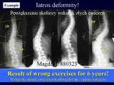 New Fundamental Knowledge on Scoliosis. SCIENCE versus OPINION / LECTURE