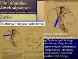 CEREBRAL PALSY, MPDZ / Mozgowe porazenie dziec. IZP. LECTURE