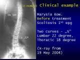 TWO LECTURES on scoliosis / Orthop.Congress in CAIRO-8.12.2006