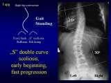 TWO LECTURES on scoliosis / Orthop.Congress in CAIRO-8.12.2006